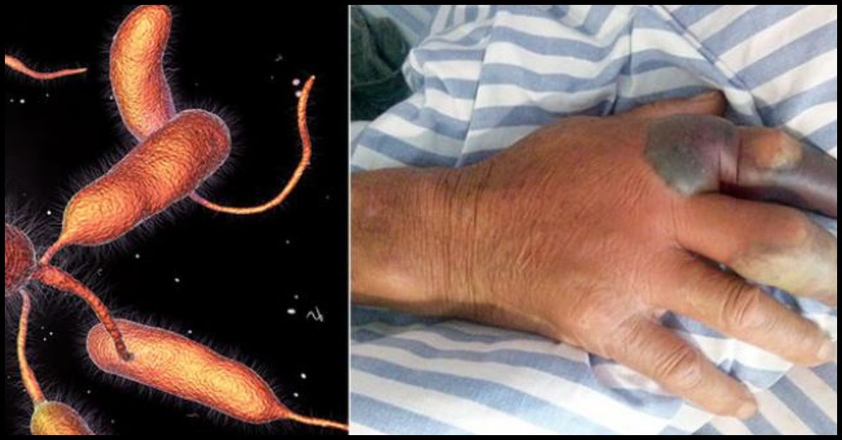 Flesh Eating Bacteria Florida