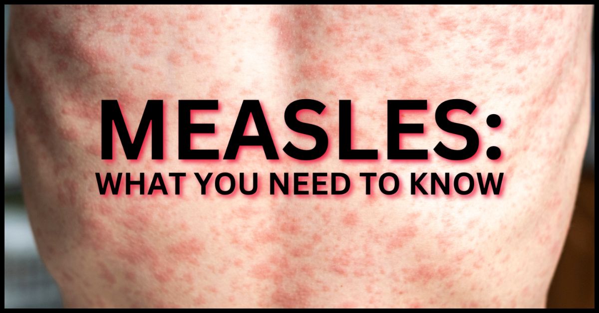 Rubella rash vs Measles rash
